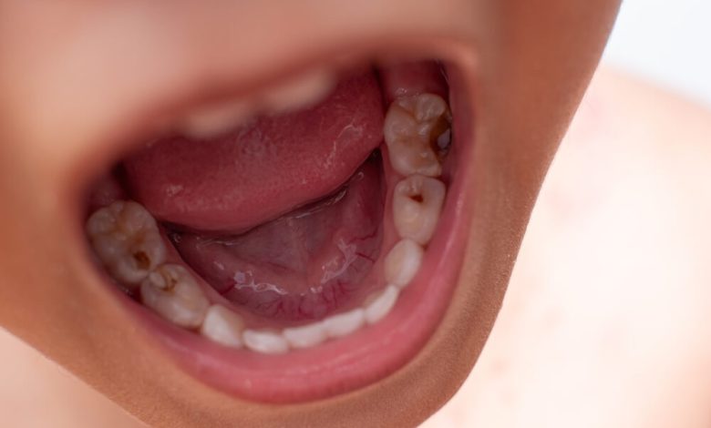 What Do Cavities Look Like A Guide To Identifying Tooth Decay